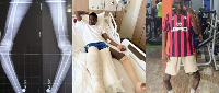 Baddy of Lagos' leg surgery