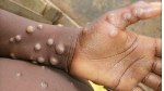Monkeypox disease